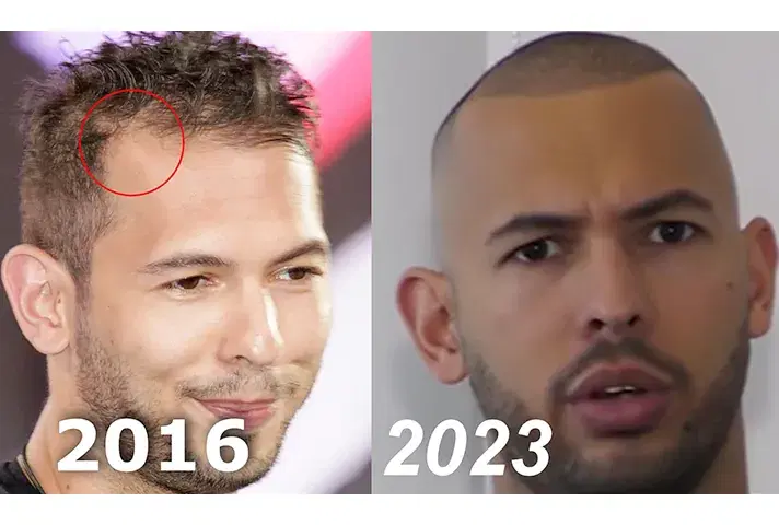 Andrew Tate Hair Transplant Result