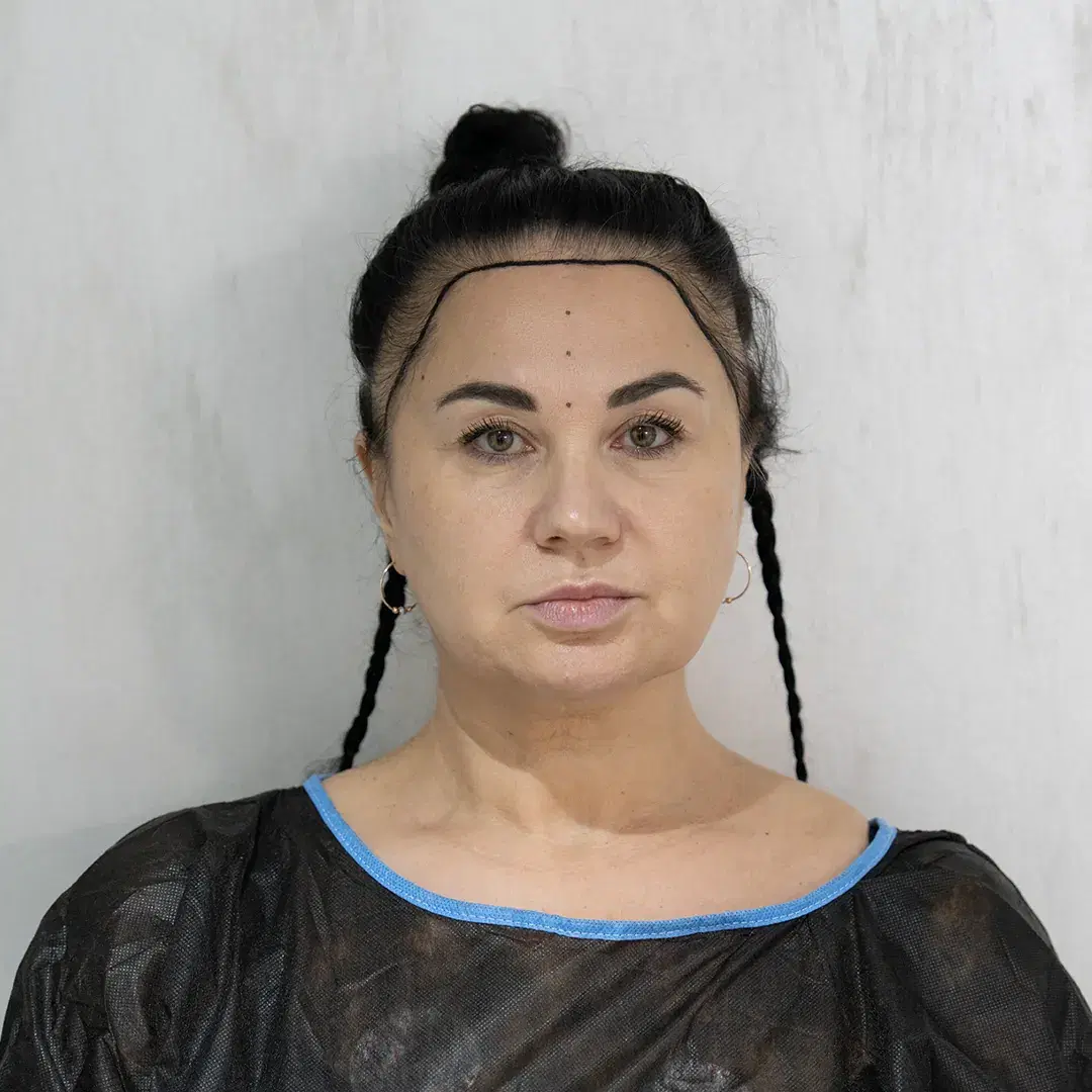 <h3><span style="color: rgb(247, 248, 248);">Before the Procedure</span></h3>