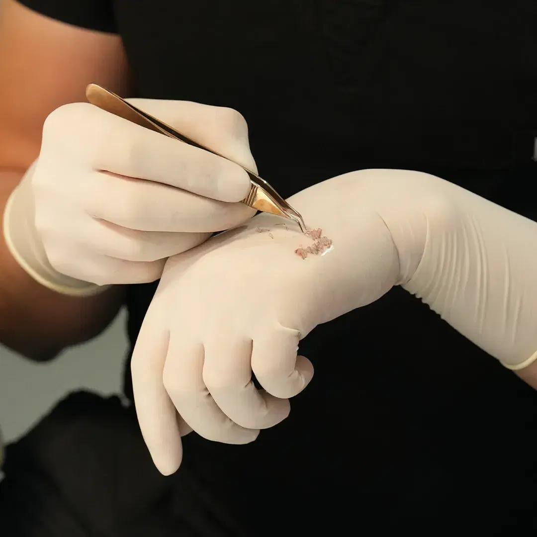 <h3><span style="color: rgb(247, 248, 248);"><strong>Loading the Choi Implanter Pen</strong></span></h3>