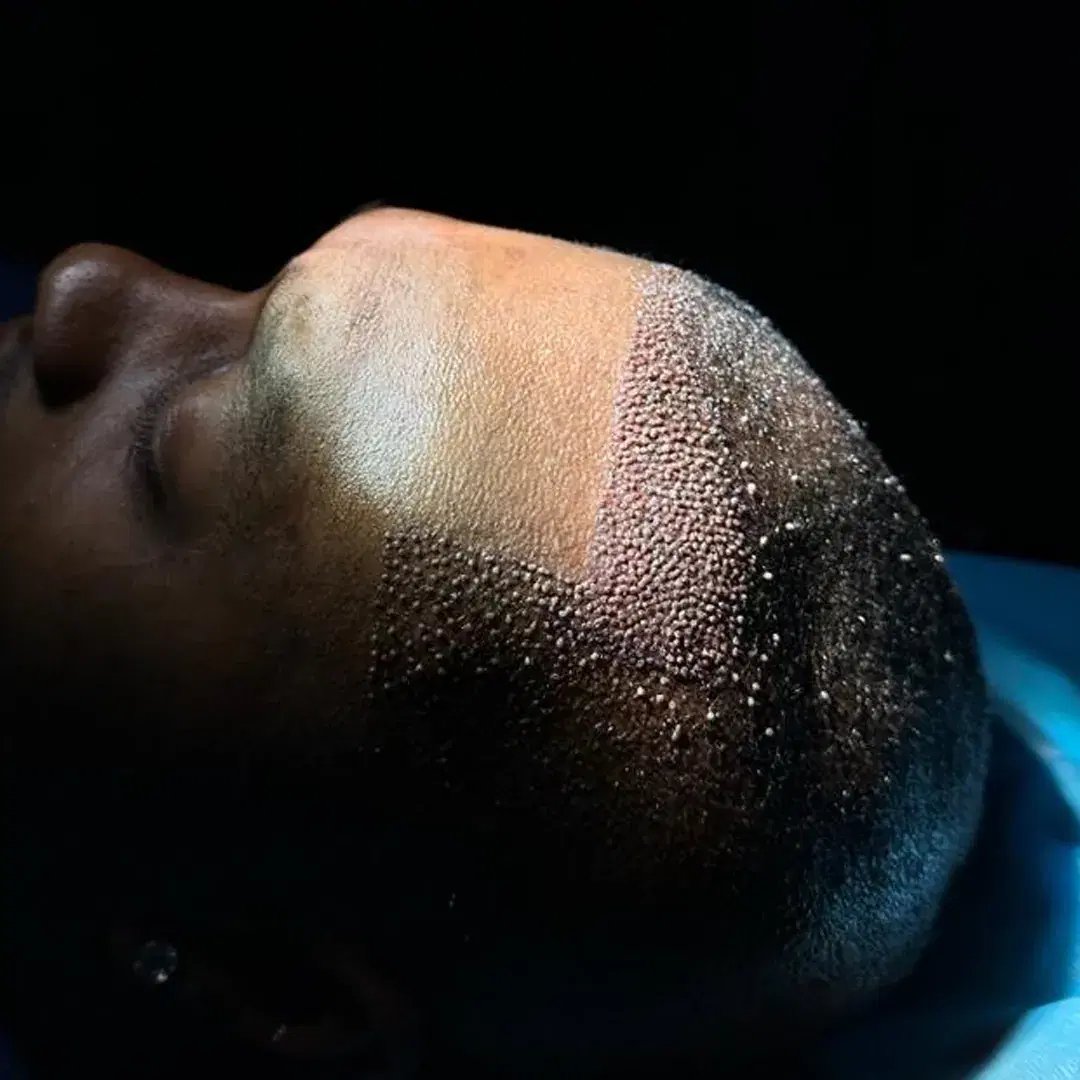 <h3><span style="color: rgb(247, 248, 248);">Implantation into the Recipient Area</span></h3>