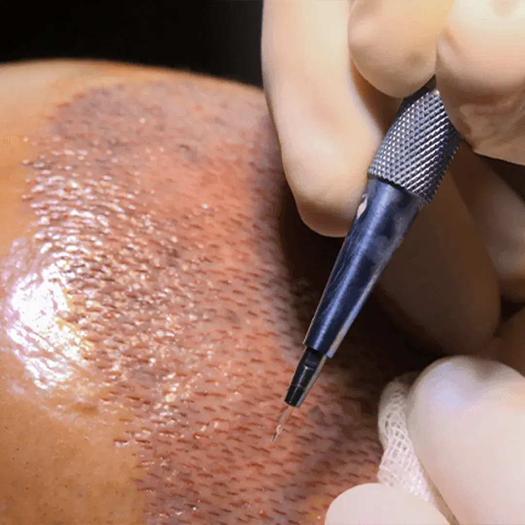 Sapphire FUE Hair Transplant